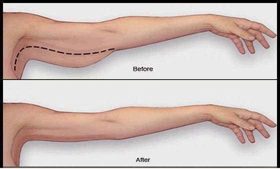 arm before and after
